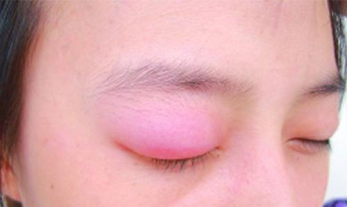 上眼皮肿是什么原因 眼皮肿如何消肿