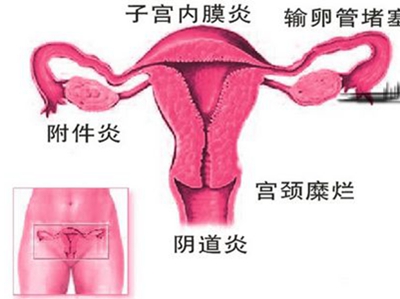 宫颈糜烂好治吗？