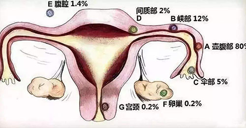 盆腔炎会腰疼吗 女性盆腔炎有哪些症状