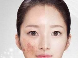 吃什么药可以治疗痤疮