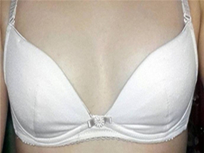 浆细胞性乳腺炎的治疗方法
