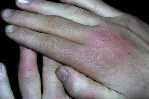 “冻伤”的意思 你一定要懂得