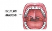 扁桃体发炎怎么办 扁桃体发炎的原因
