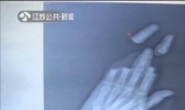 狂风突袭！两男子被风筝线勒断手掌四指 疼得钻心啊！