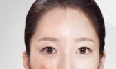 吃什么药可以治疗痤疮
