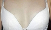 浆细胞性乳腺炎的治疗方法