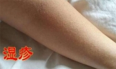 湿疹会不会传染 湿疹怎么治