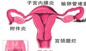 宫颈糜烂好治吗？