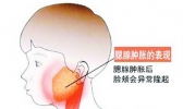 腮腺炎的早期症状 腮腺炎怎么治疗