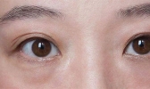 上眼皮肿是什么原因 眼皮肿如何消肿