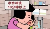 烫伤后处理方法，烫伤的家庭处理小妙招
