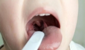 扁桃体肥大怎么办 帮助扁桃体消肿的食疗