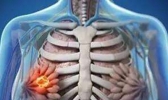 乳腺增生会复发吗