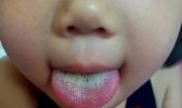 宝宝舌苔厚白是怎么回事 该如何护理